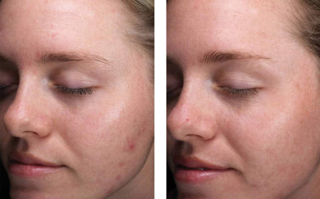 face serum for oily skin